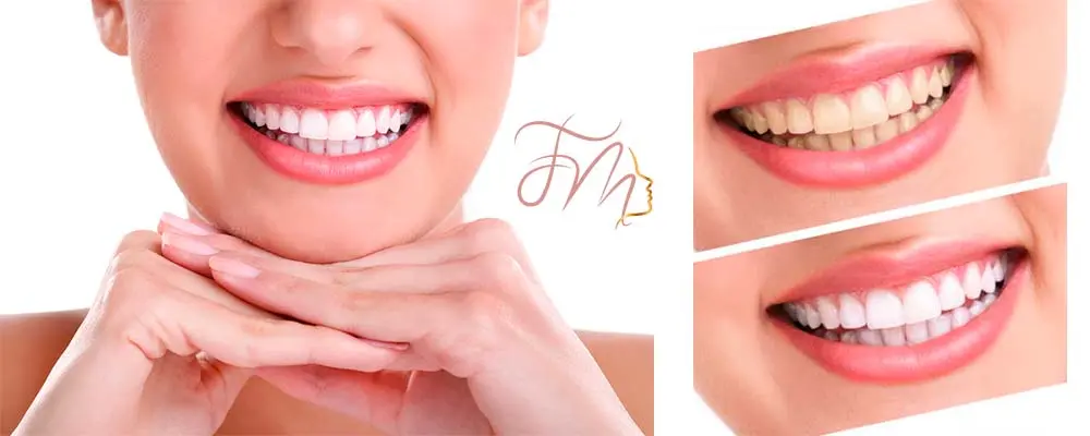 Clareamento Dental no Vale do Itajaí - Dra. Franciele Macedo Odontologia em Blumenau, Vale do Itajaí/SC. Clareamento Dental no Vale do Itajaí - Dra. Franciele Macedo Odontologia em Blumenau, Vale do Itajaí/SC.