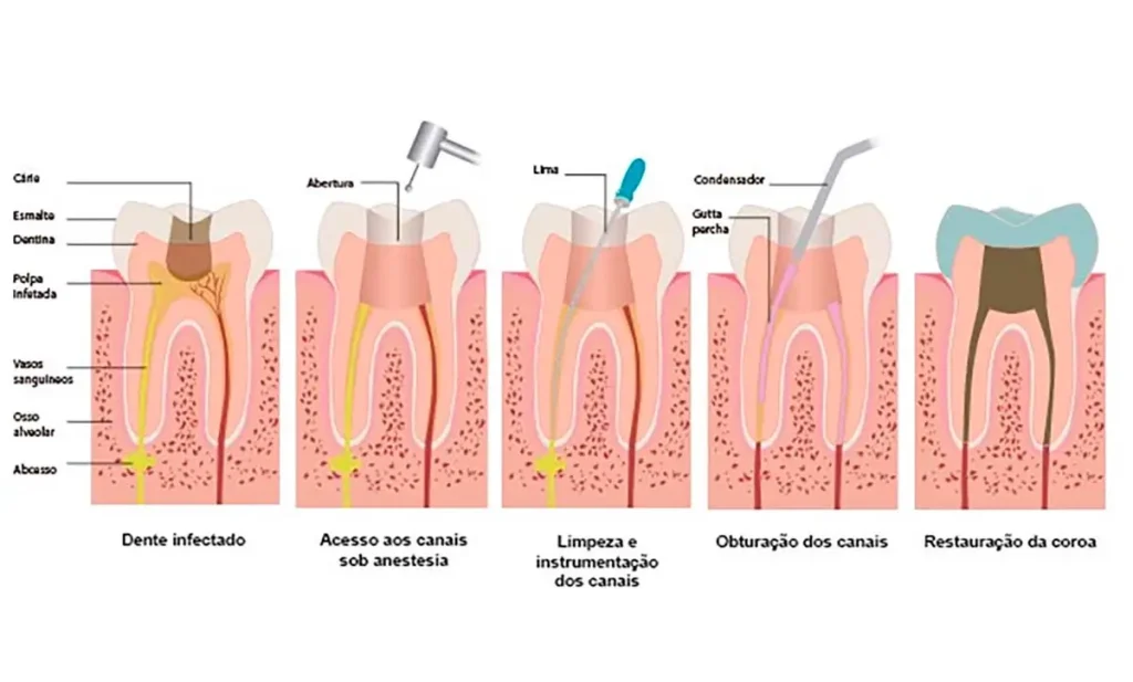 O que é Endodontia?, O que Trata Esta Especialidade? - Dra. Franciele Macedo Especialista em Endodontia em Blumenau, Vale do Itajaí/SC O que é Endodontia?, O que Trata Esta Especialidade? - Dra. Franciele Macedo Especialista em Endodontia em Blumenau, Vale do Itajaí/SC