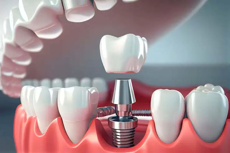 Implante Dentário em Blumenau - Carlos Gomes Odontologia