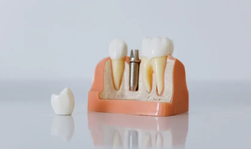 Durabilidade dos Implantes Unitários Durabilidade dos Implantes Unitários