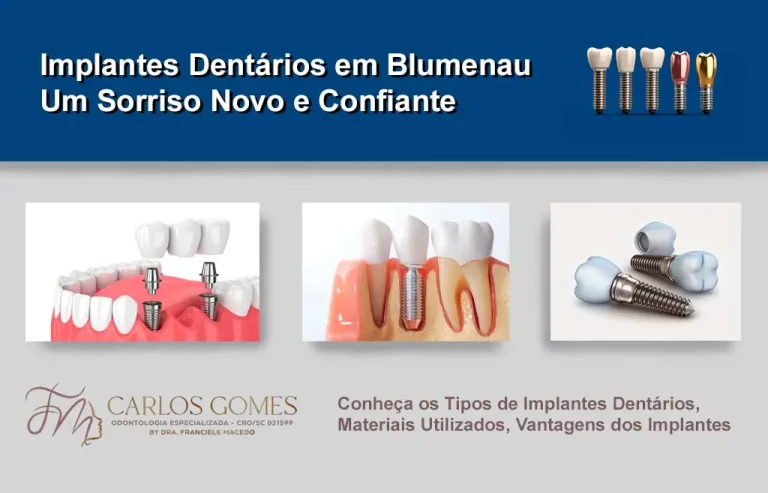 Implantes Dentários em Blumenau: Um Sorriso Novo e Confiante