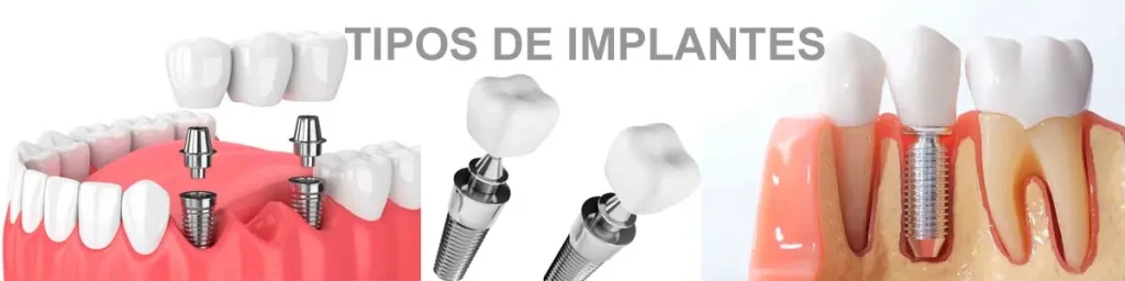 Tipos de Implantes Dentários