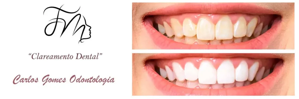 Onde Fazer Clareamento Dental?