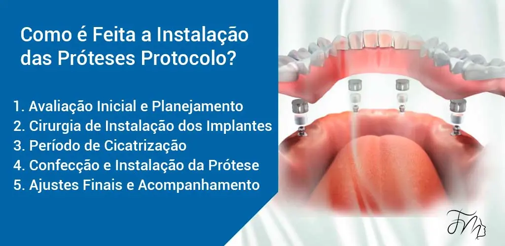 Como é Feita a Instalação das Próteses Protocolo?