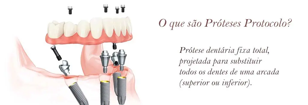 O Que São Próteses Protocolo?