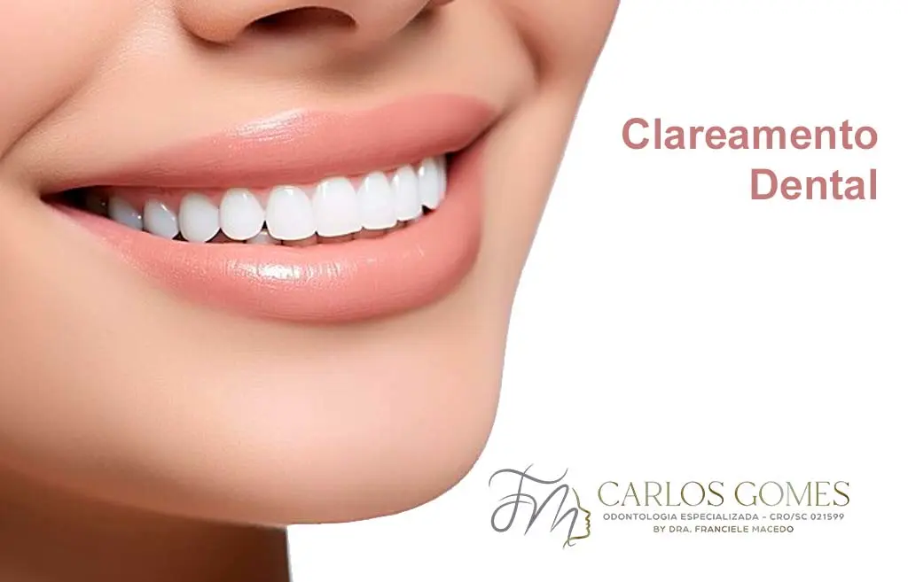 Agende uma Consulta com  um Especialista em Clareamento Dental em Blumenau - Carlos Gomes Odontologia