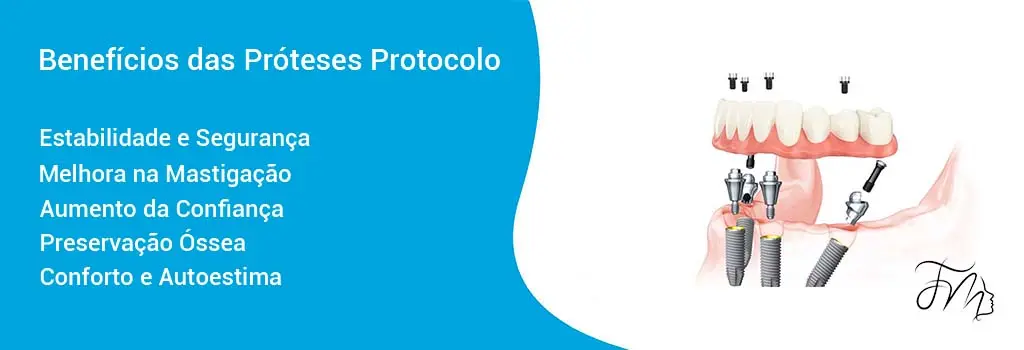 Os 10 Maiores Benefícios das Próteses Protocolo Os 10 Maiores Benefícios das Próteses Protocolo