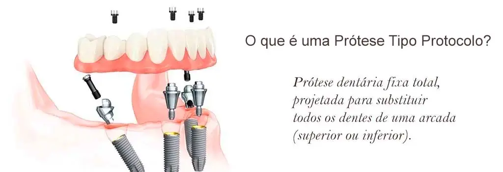 O que é uma Prótese Protocolo? Como é Instalada e Muito Mais.
