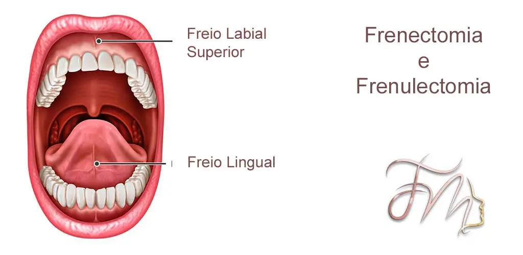 Frenectomia e Frenulectomia - Diferenças