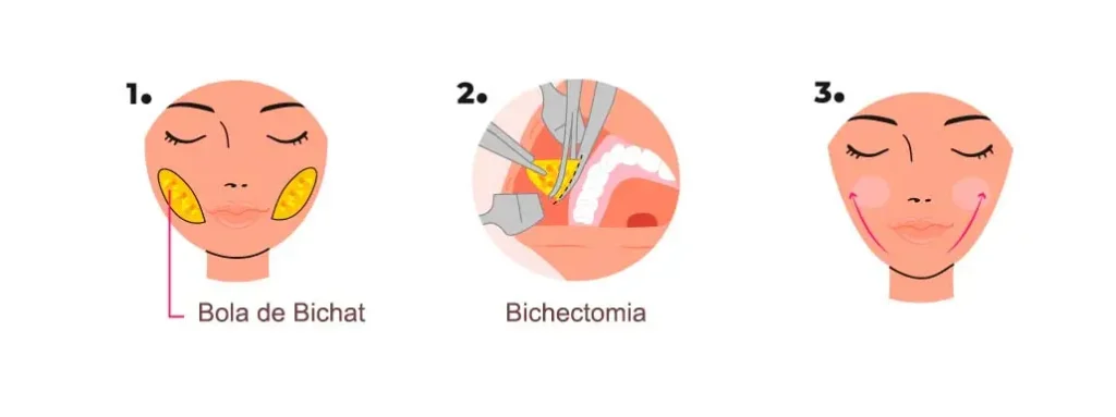 O Que É, Afinal, a Bichectomia? O Que É, Afinal, a Bichectomia?