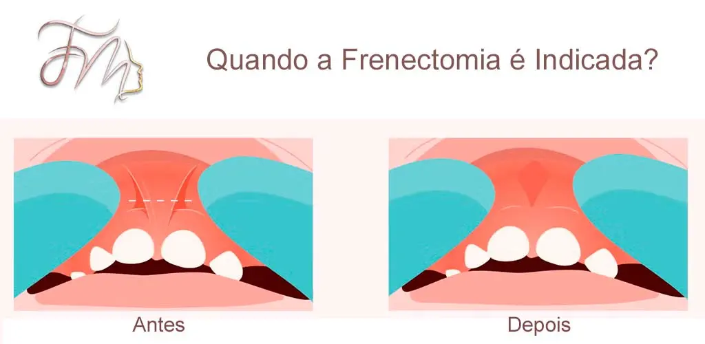 Quando a Frenectomia é Indicada?