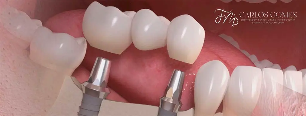 Acompanhamento profissional especializado para Implante Dentário em Blumenau - Carlos Gomes Odontologia