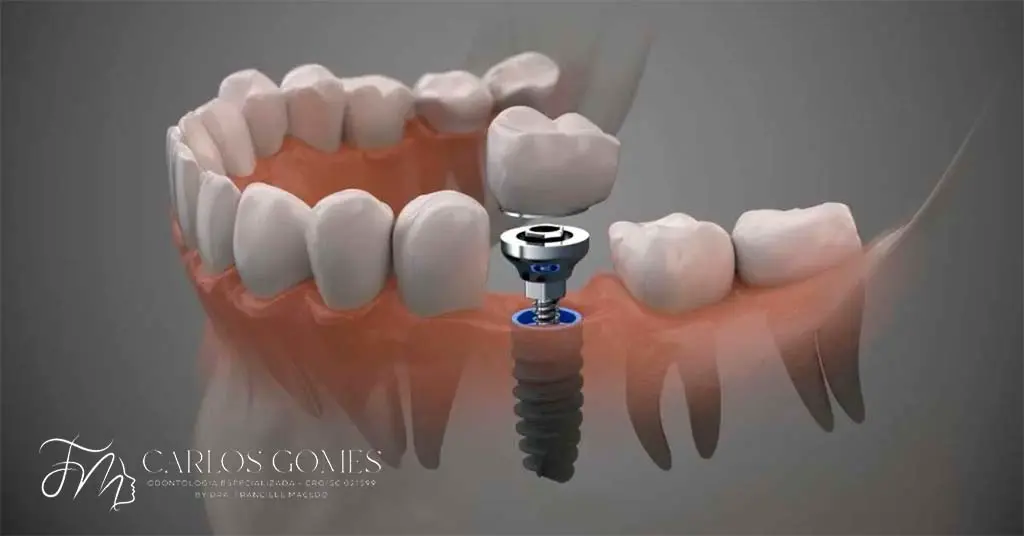 O que é um Implante Dentário? - Carlos Gomes Odontologia