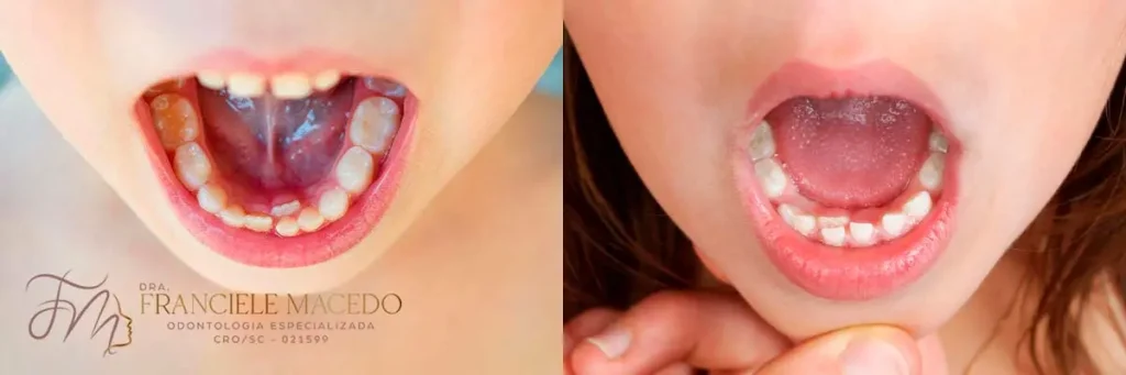 Dentes Nascendo em Fila Dupla? - Odontopediatra em Blumenau. - Dra. Franciele Macedo Odontologia Especializada.